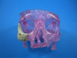 3d-printed facial implant.